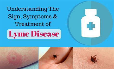 How To Know You Have Lyme Disease Signs Symptoms And Its Treatment