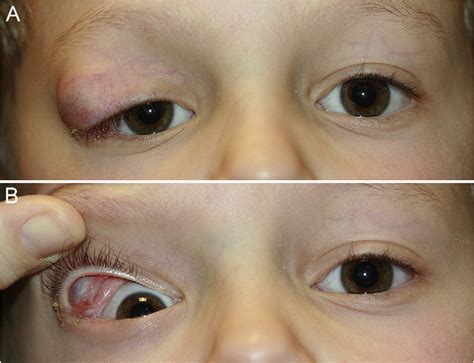 developmental conjunctival cyst   eyelid   child semantic scholar