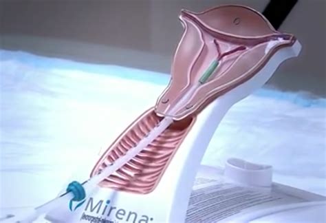 compensation  mirena iud victims requiring removal surgery sign