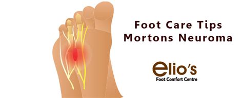 Morton S Neuroma Treatments Morton S Toe Foot Health Niagara