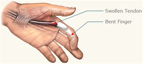 trigger finger  symptoms splint exercises treatment