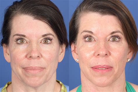 Facelift Before And After 52 Weber Facial Plastic Surgery