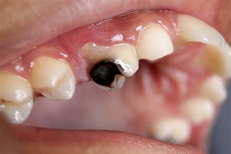 rotten teeth  children pathak dental