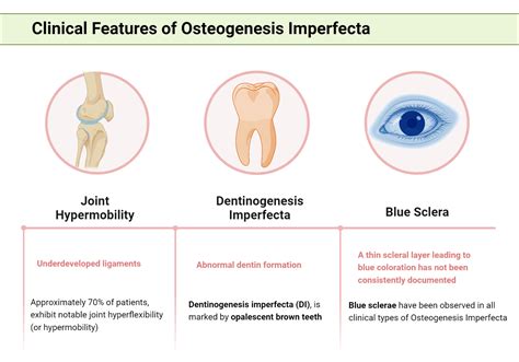 Osteogenesis Imperfecta Symptoms And Signs My Endo Consult
