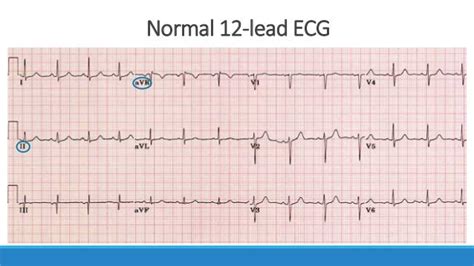 ecg step  step approach updated