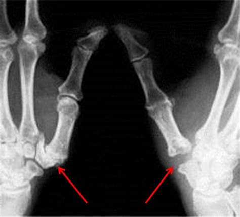 basilar joint arthritis      washington