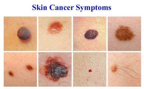Skin Cancer – Blue Velvet