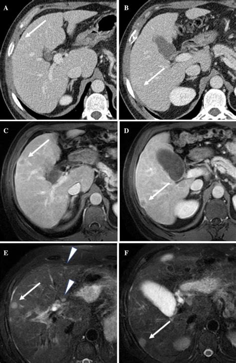 Comparison Of Conspicuity Of Liver Metastases On A And B Post Contrast
