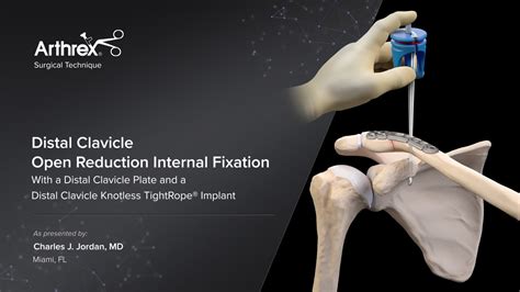 arthrex distal clavicle open reduction internal fixation