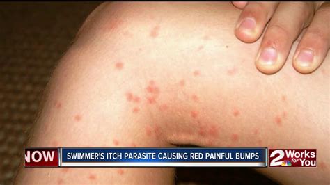 hnu swimmers itch parasite causing red painful bumps youtube