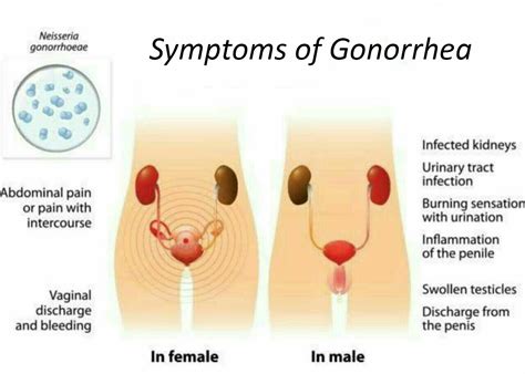Gonorrhea Causes Symptoms And Treatment Options For Men