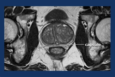 The Radiology Assistant Prostate Cancer Pi Rads V2