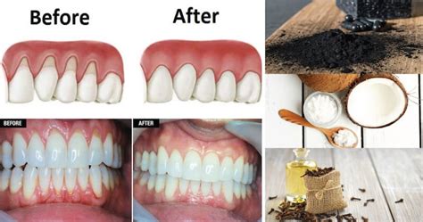 natural remedies   grow   receding gums