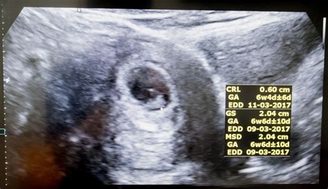 is a fetal heartbeat really a heartbeat at 6 weeks live science