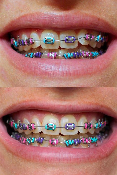 purple pink blue dientes con brackets brackets dentales ligas