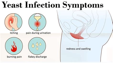 Yeast Infection Symptoms How You Can Diagnose The Severe