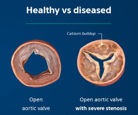 severe aortic valve stenosis boston scientific