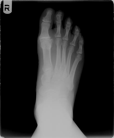 dr  lam straight talk joint pain arthritis   big toe
