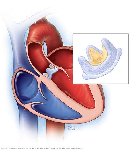 Aortic Valve Stenosis Diagnosis And Treatment Mayo Clinic