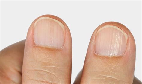 vitamin b12 deficiency symptoms the sign in your nails