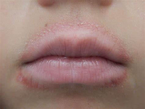 rash   lips  siteliporg