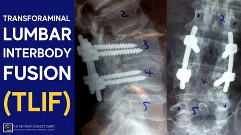 Transforaminal Lumbar Interbody Fusion Tlif Centeno Schultz Clinic