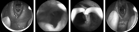 Hysteroscopic View Of The Intact Hymen Before A And B During C