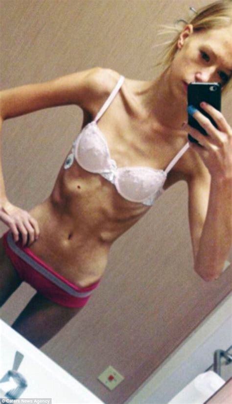 swedish anorexic turned life around and became a personal