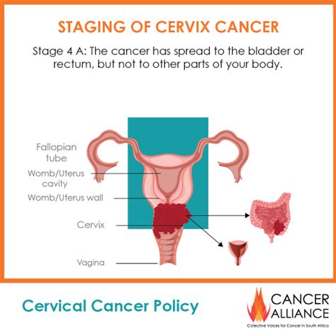 Cervical Cancer Policy 4 Timely Treatment And Palliative Care For