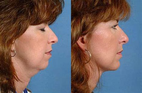 neck procedures   photo gallery louisville ky calospa rejuvenation center