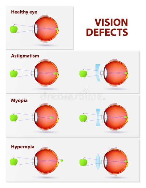 astigmatism myopia and hyperopia stock vector