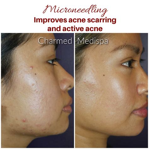 improvement  acne scarring  active acne  microneedling skinpen