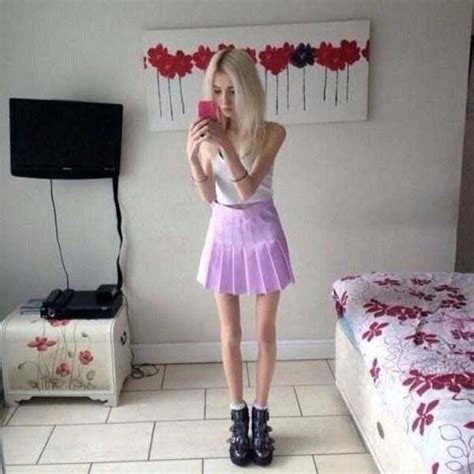 30 Shocking Pics Of Anorexic Girls Klyker Com