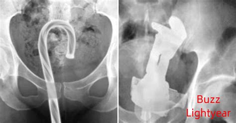 Very Unusual Objects Stuck Inside People’s Orifices That