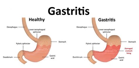 Gastritis Apa Penyebab Gejala Dan Tindakan Pencegahannya