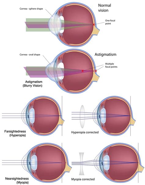 astigmatism and hyperopia astigmatism glaucoma swollen