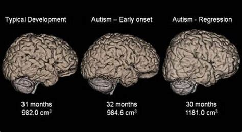 Mri Technique Shows Brain Differences In People On Autism