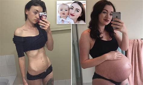 pregnancy saved my life anorexic woman says a surprise