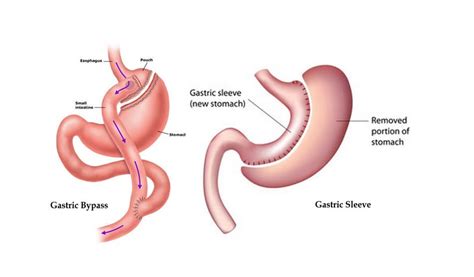 Key Difference Between Gastric Sleeve And Gastric Bypass Surgery