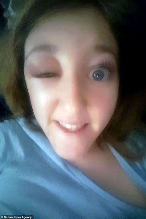 Hairdresser 26 Left With A Bulging Eye After Surgery To Remove A