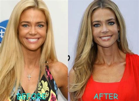 Denise Richards Plastic Surgery Breast Implants Before And