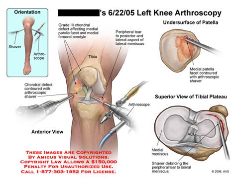 Amicus Illustration Of Amicus Surgery Knee Arthroscopy