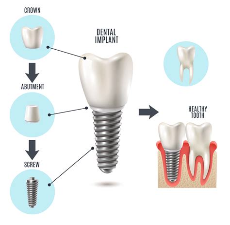 dental implants pain plano tx imagecare dental