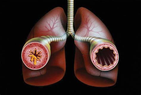 astma bronkiale trajtimi gazeta shendeti