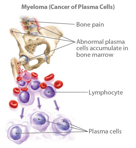 multiple myeloma information facts overview ctca