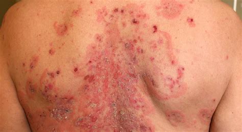 4 common myths about psoriasis easton dermatology associates