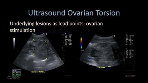 imaging ovarian torsion youtube