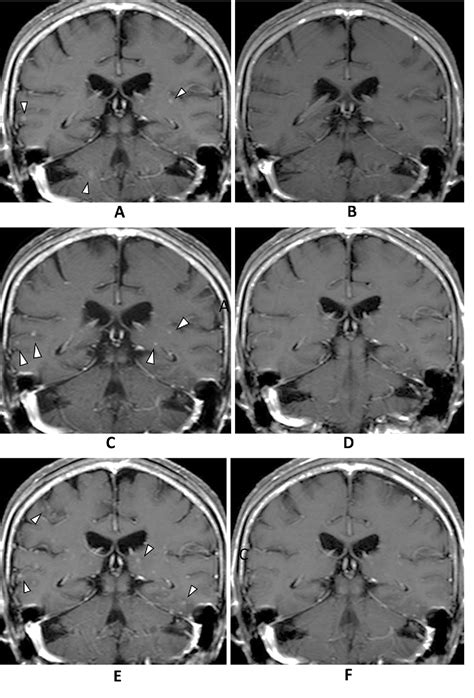 Figure 1 From Afatinib Therapy For Brain Metastases Aggravated By A