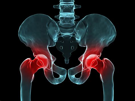 hip bursitis   pain  impede mobility university health news