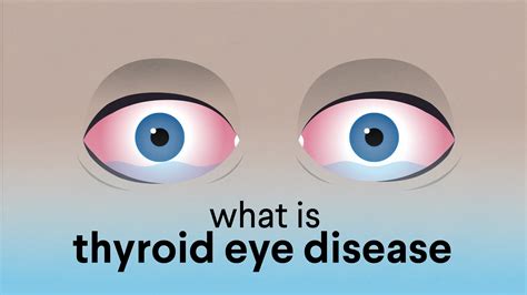 thyroid eye disease american association  clinical